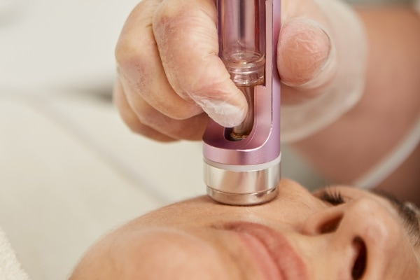 Microneedling (percutane collagen inductie)​